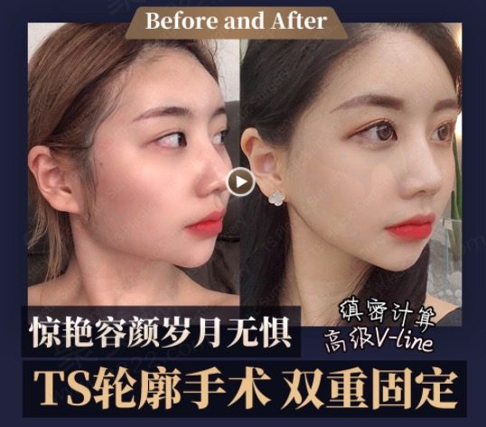 韩国TS整形外科医院颧骨+下颌角手术