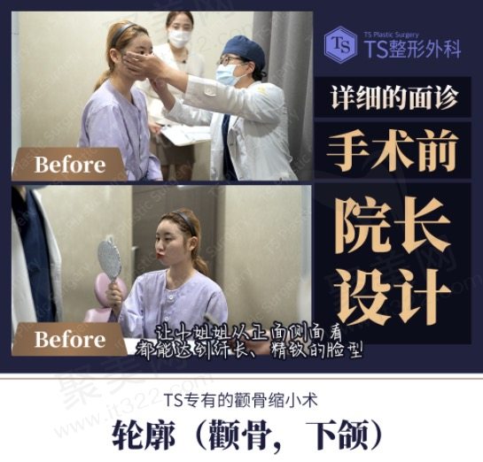 韩国TS整形外科医院颧骨+下颌角手术咨询中