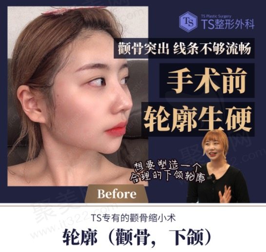 韩国TS整形外科医院颧骨+下颌角手术前