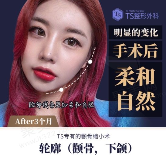 韩国TS整形外科医院颧骨+下颌角手术后三个月