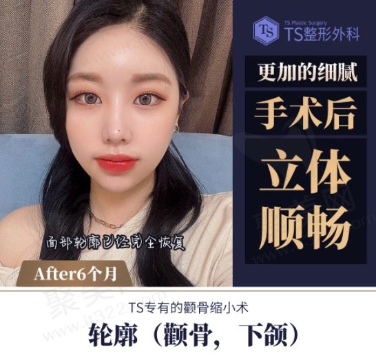 韩国TS整形外科医院颧骨+下颌角手术后六个月