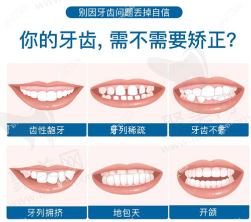 金属托槽矫正