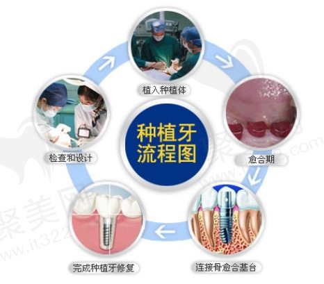 泰安和睦口腔医院韩国登腾种植牙流程