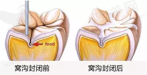 窝沟封闭