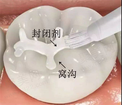 窝沟封闭