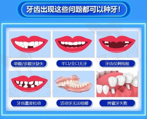 台州路桥口腔医院韩国纽百特种植牙价格