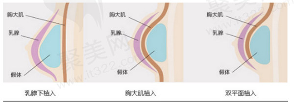 北京煤医医疗美容医院 隆胸