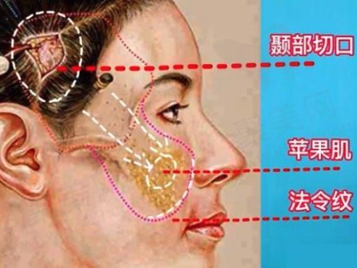 北京排名前十医院拉皮手术价格一览表