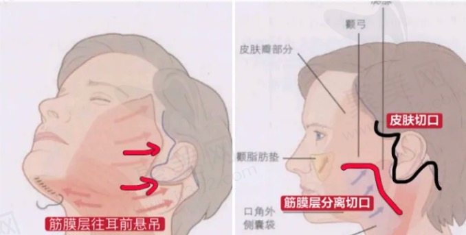 面部拉皮手术的费用构成都有哪些呢？