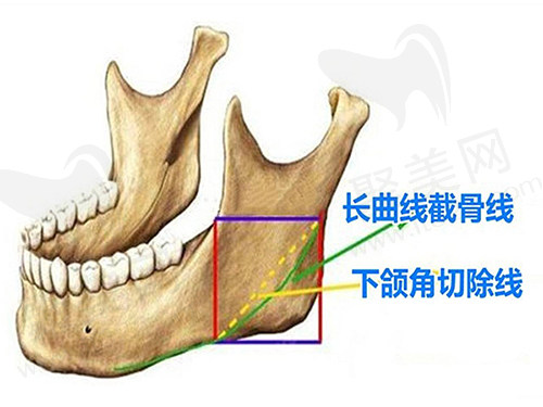 广州广大做下颌角怎么样