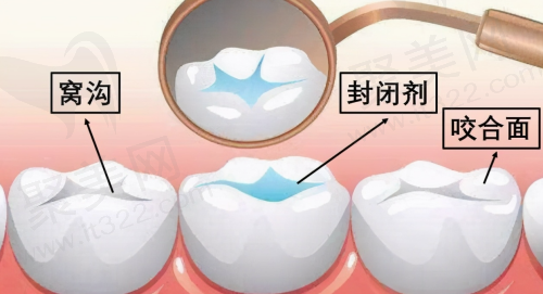 儿童牙齿涂氟 窝沟封闭