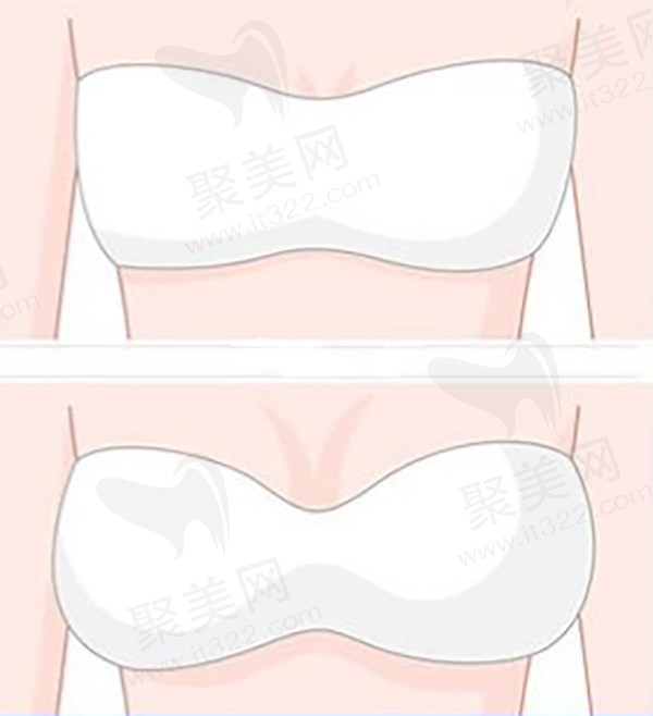 5C脂肪艺术丰胸技术