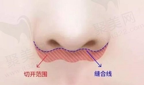 深圳福雅胡俊杰医生人中缩短术
