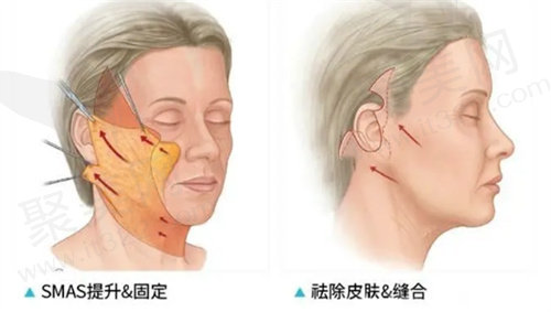 北京华韩高亚东小拉皮
