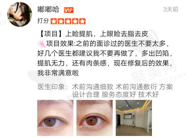 杜园园双眼皮修复口碑评价