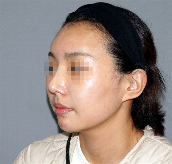 韩国优雅人术后