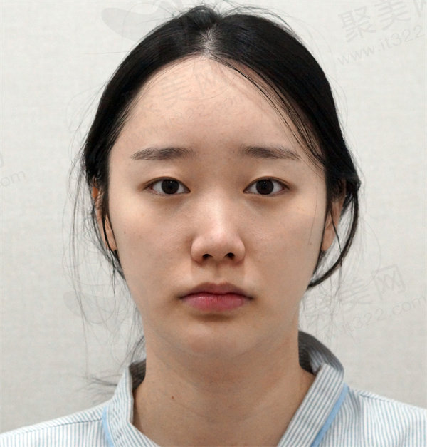 韩国优雅人术前