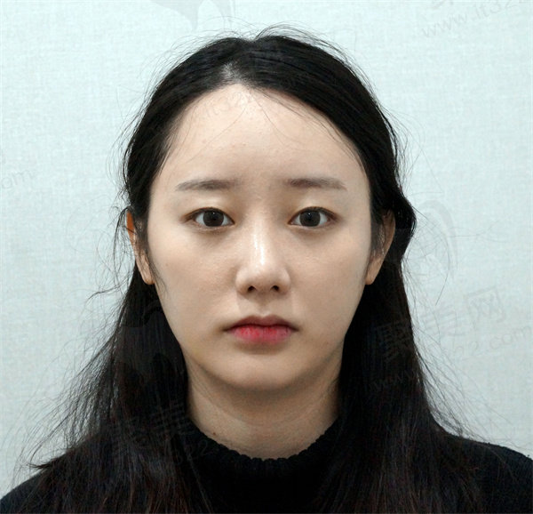 韩国优雅人术后