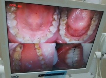抚州英伦口腔医院种牙