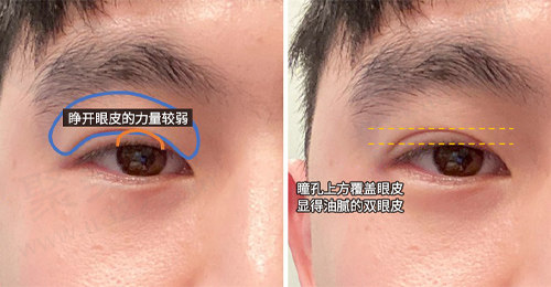 术前分析眼部所在问题