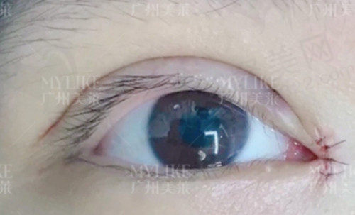 陈贵宗医生割双眼皮术后即可病例图