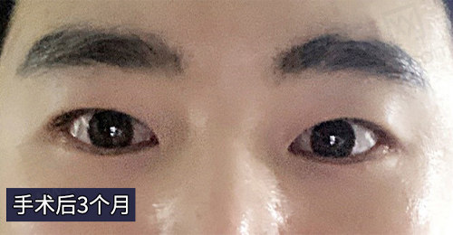 手术后三个月的样子
