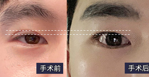 求美者术前术后对比