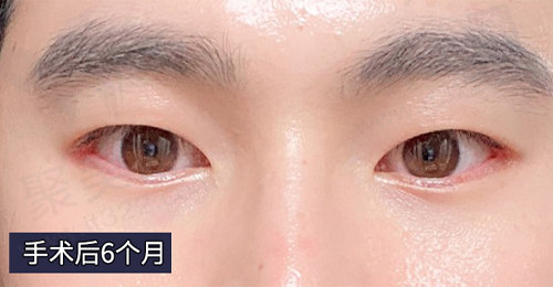 求美者术后6个月的变化