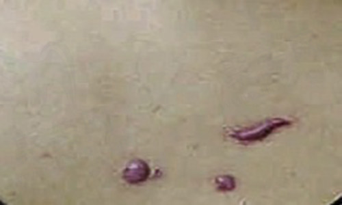 疤痕修复