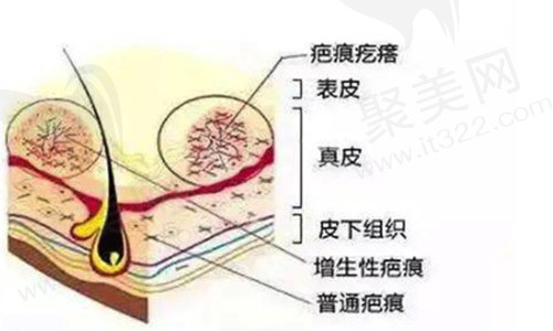 疤痕修复
