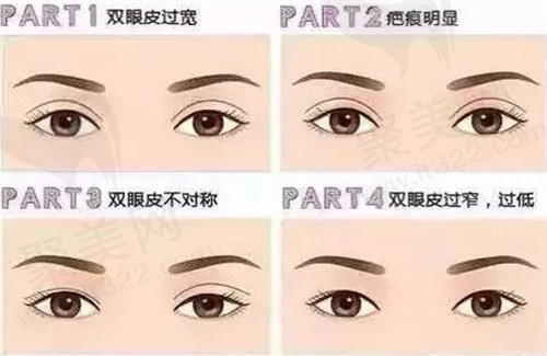 眼部整形