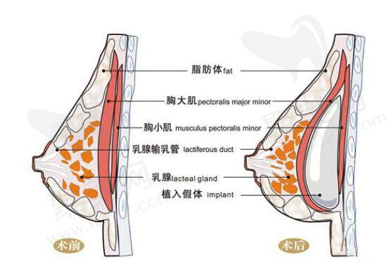捷克丰胸针的维持时间