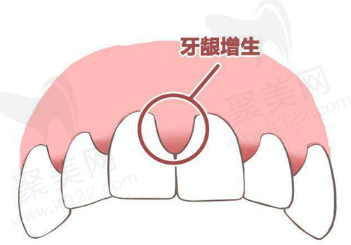 牙龈脓肿增生