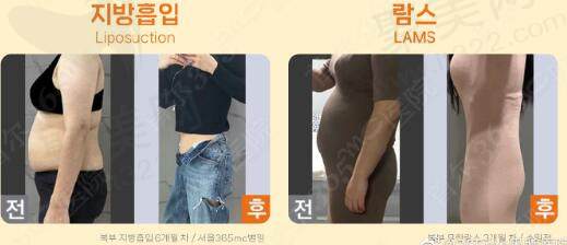 韩国365mc吸脂医院兰斯lams腰腹对比