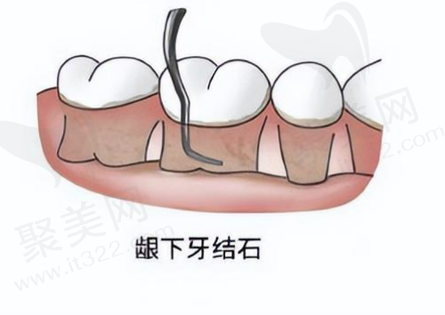 龈下牙结石