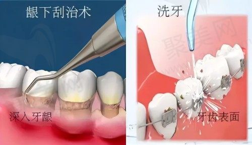 龈下刮治和洗牙的区别