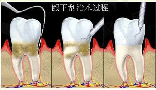 龈下刮治的过程