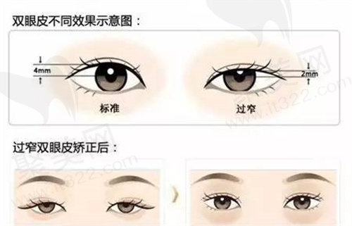 双眼皮