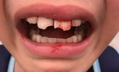 小孩门牙磕掉一小块怎么修复