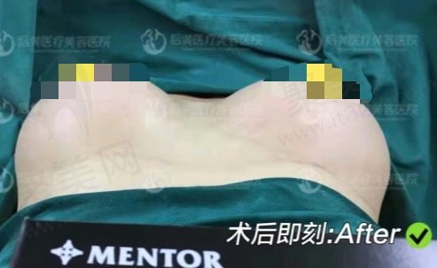 薛瑞隆胸术后即刻实例图