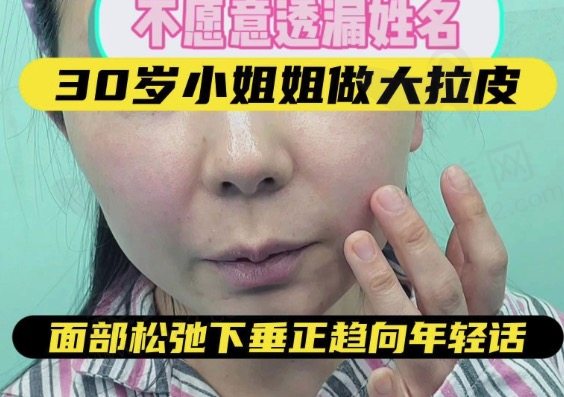 30岁做面部拉皮是否适合？