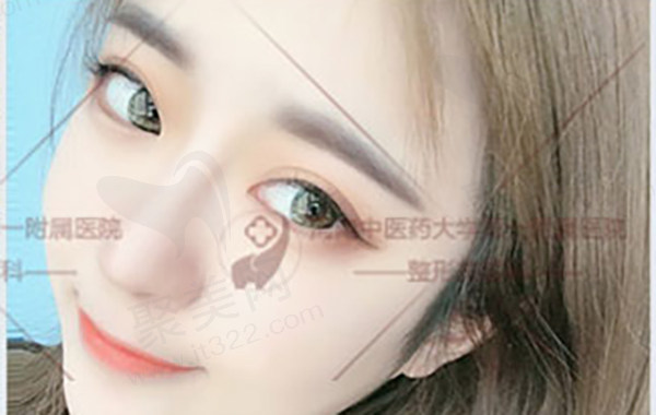 郑州葛艳娜做双眼皮怎么样