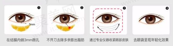 不开刀祛眼袋优势