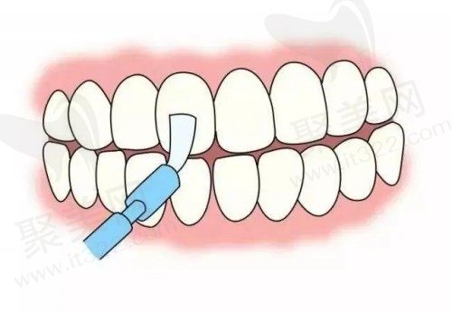 给孩子涂氟好不好