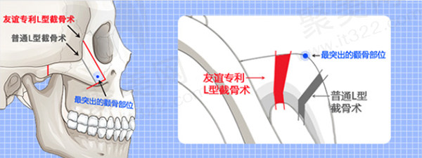 成都友谊医院做正颌手术多少钱