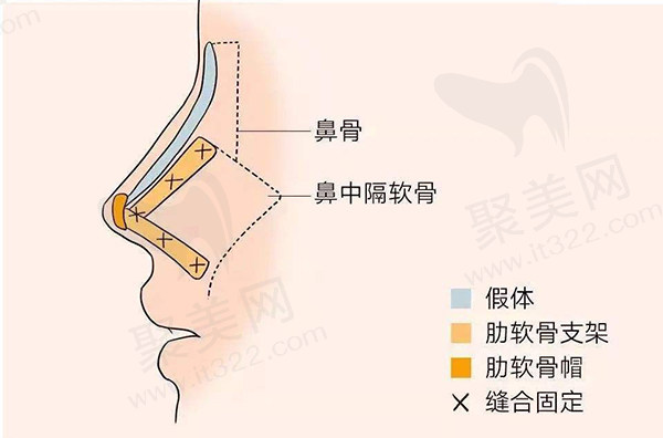 四川友谊医院鼻子手术哪一个好