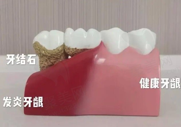 洗牙会让牙齿松动吗