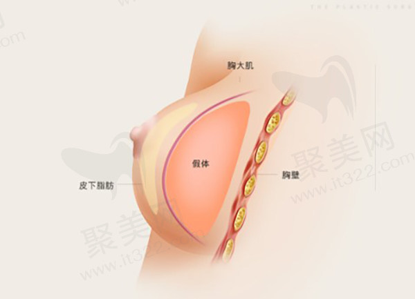 宝俪M系列圆形毛面假体隆胸