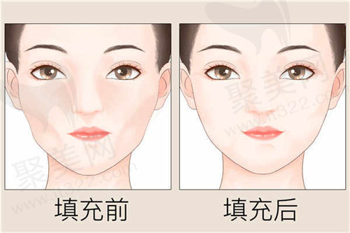 玻尿酸