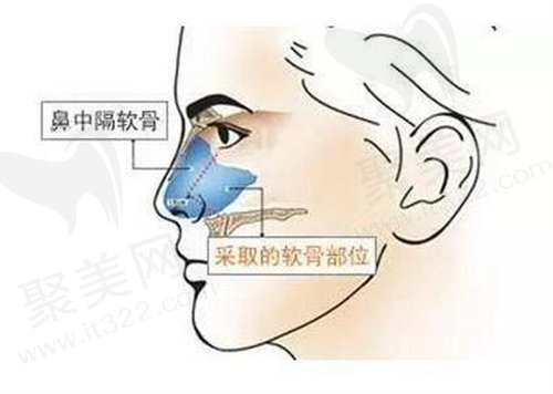 鼻修复技术